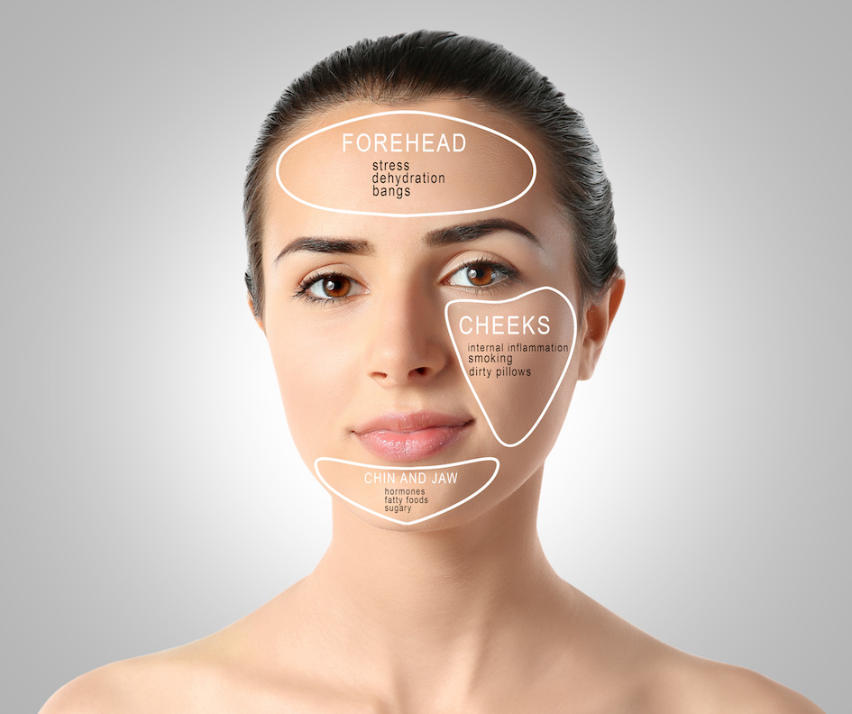 Verstehst du die Pickel in deinem Gesicht? Face Mapping Akne und Pickel verstehen woher diese kommen