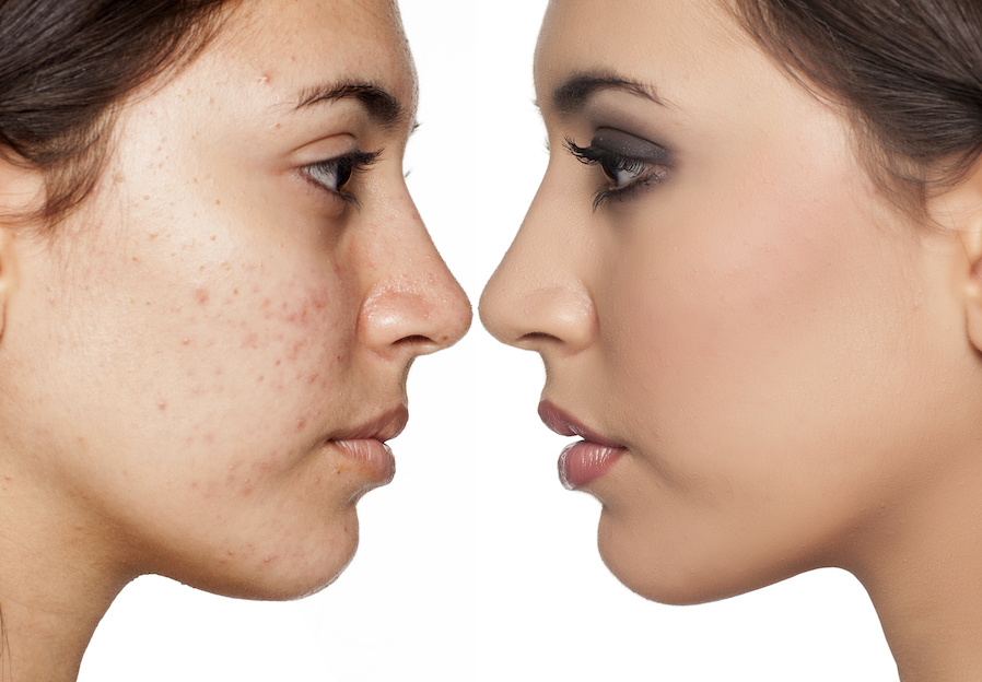 Unreine Haut - Hautreinigung und Hautpflege